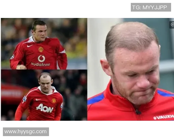 土耳其植发技术助力足球明星重塑自信与风采